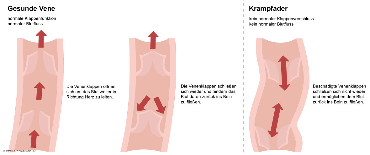 Vergleich der Funktion einer gesunden Vene mit einer Krampfader (Grafik www.die-varikose.de, 13.04.2019)